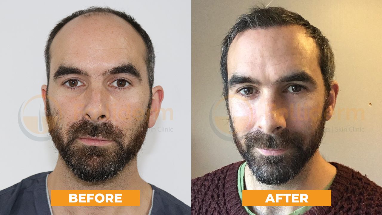 Hair Transplant Experience & Testimonials from Mr. Andrew's from England