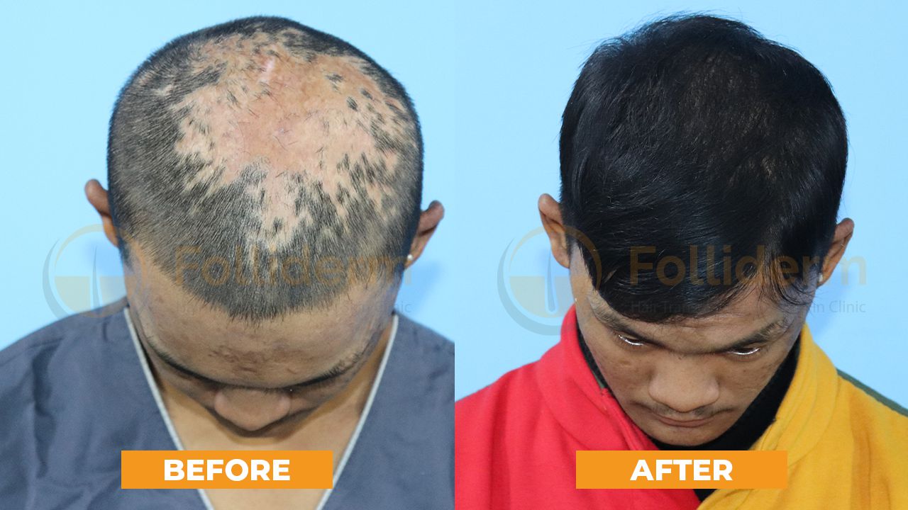 Hair Transplant in Nepal With DHT Technique | Folliderm