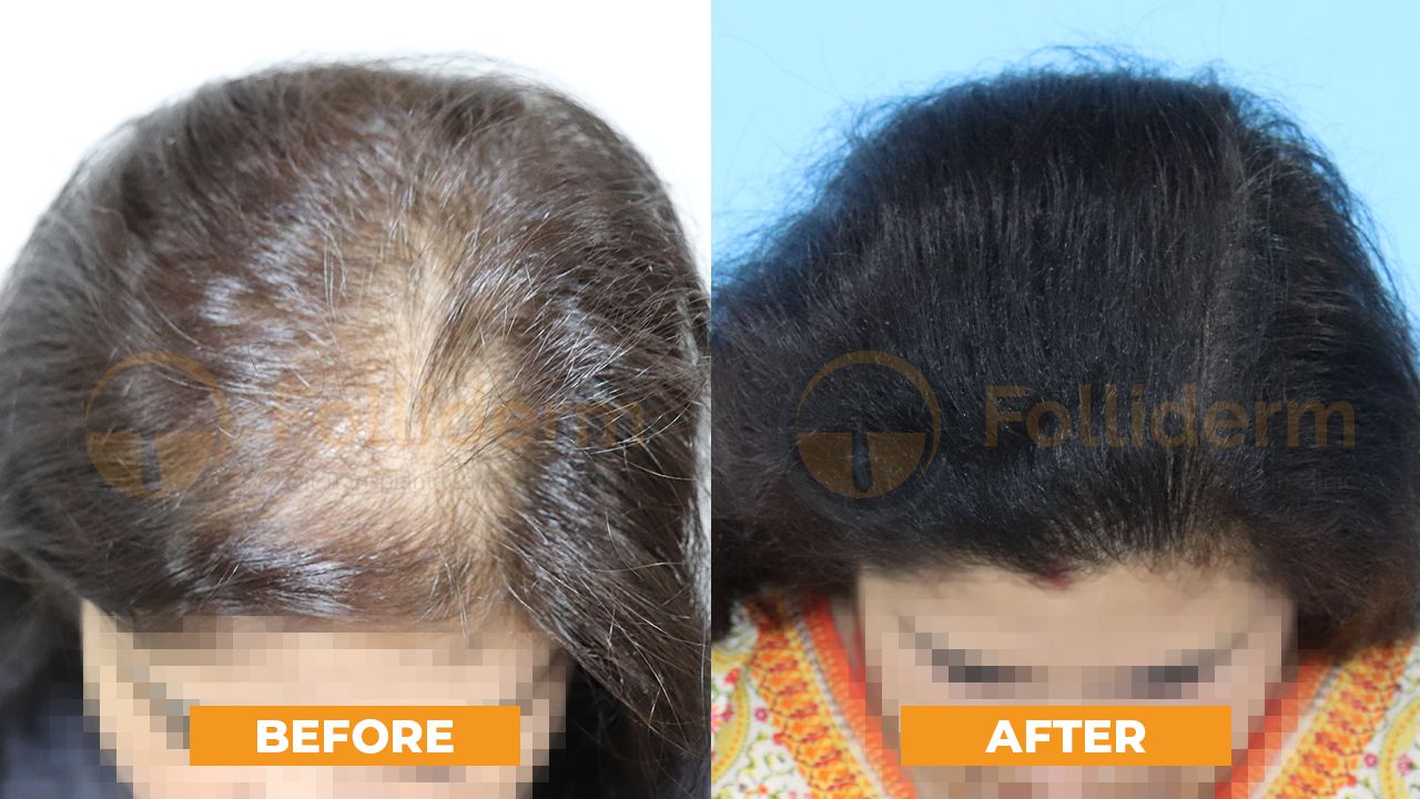 Hair Transplant in Nepal With DHT Technique | Folliderm