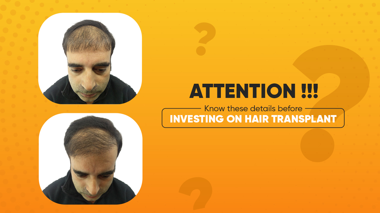 Cheapest Hair Transplant in Nepal? Is it worth it?